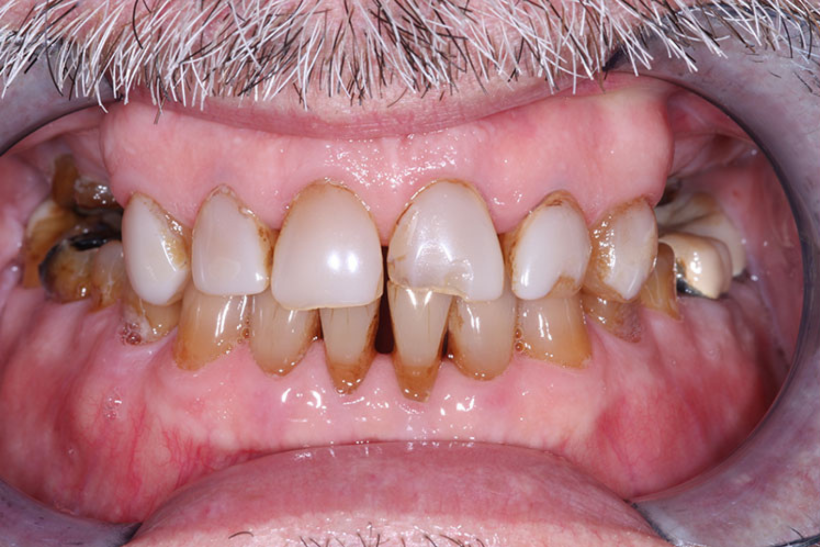 before